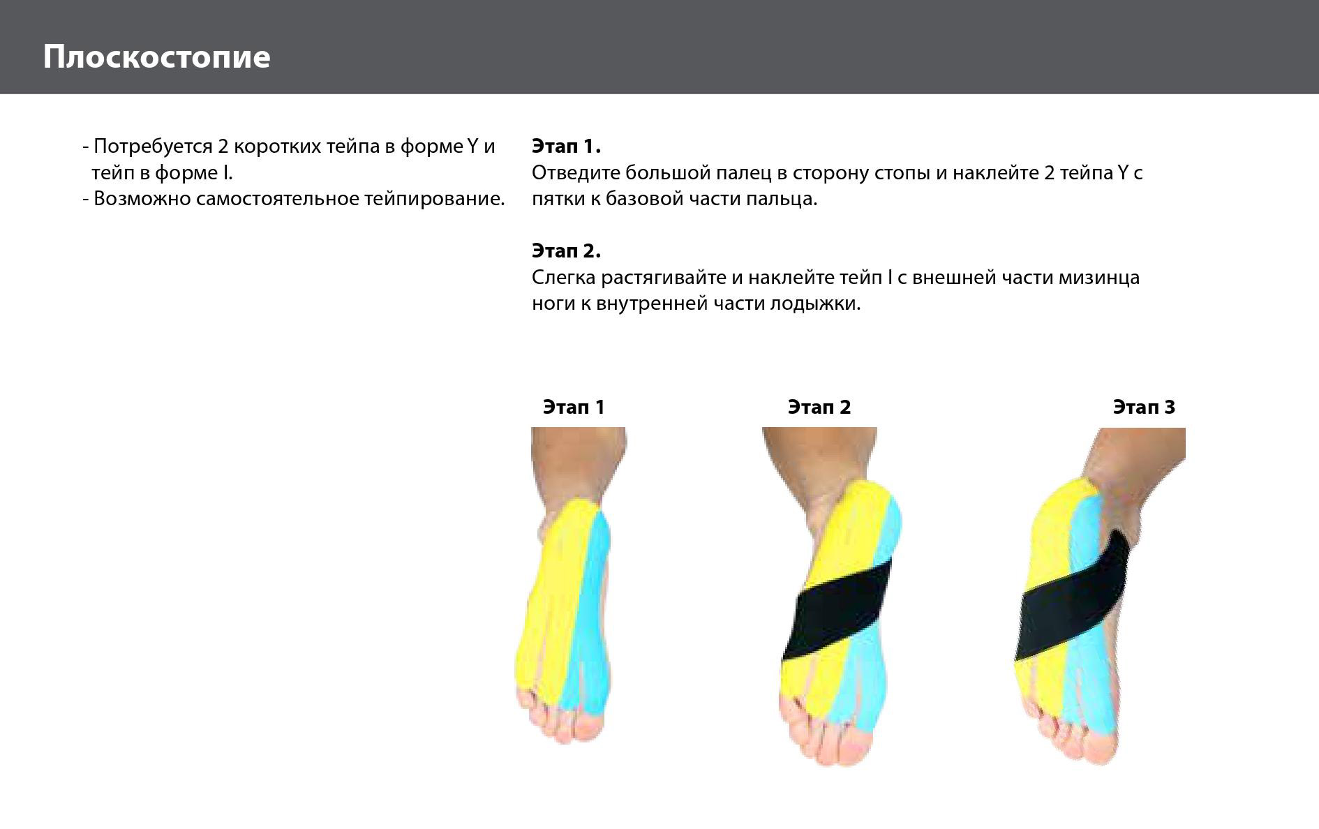 Тейпирование при плоскостопии у взрослых схемы