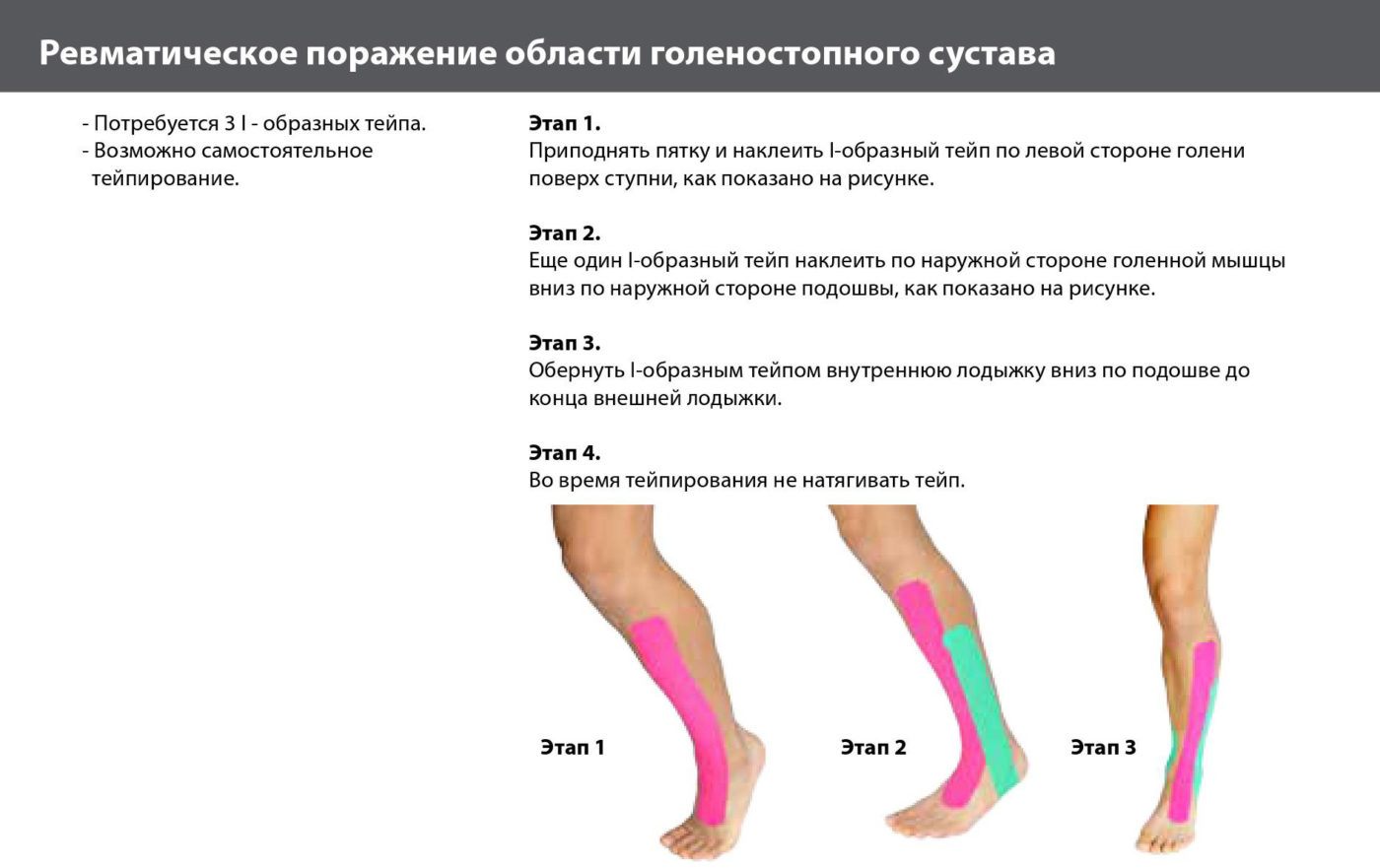 Тейпы при растяжении голеностопа схема